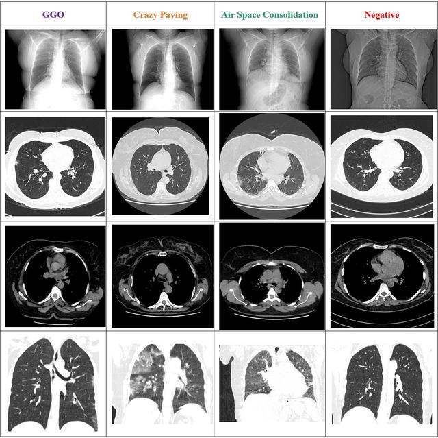 HRCTv1-COVID-19 Dataset